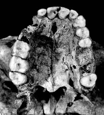 Esta fotografia mostra arcada dentária, desta vez superior, apresentando a falta de alguns dentes e a deterioração de outros.
