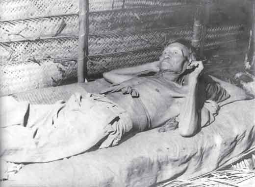 Fotografia revela senhor sem camisa deitado em um colchão. Nota-se o contorno dos ossos sob a pele, além dos olhos arregalados. Percebe-se ainda que está dentro de uma construção feita de palha e madeira.