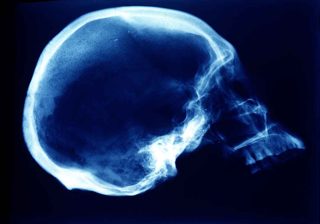 A imagem mostra uma radiografia de um crânio de perfil.