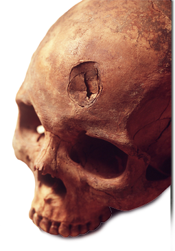 Foto aumentada de um crânio com fratura frontal.