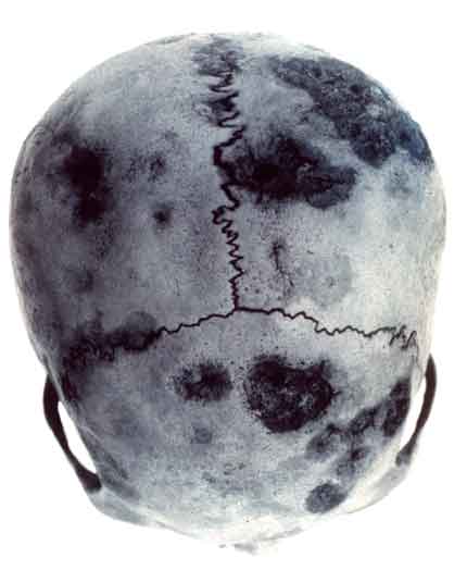 A foto revela o topo de um crânio com rachaduras.