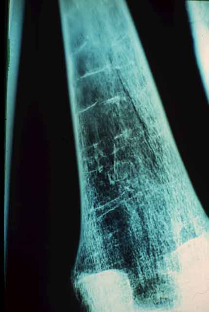 A imagem mostra um fêmur radiografado.