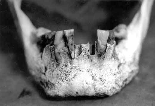 A foto em preto e branco é um close de mandíbula humana com perda de dentes inferiores.