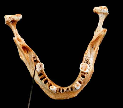 A imagem mostra uma mandíbula inferior onde se percebe a falta de vários dentes.