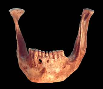 A foto mostra lesões dentárias em mandíbula inferior.