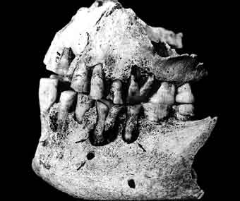 A foto mostra arcada dentária de perfil com avarias e perda óssea, além de um dente em destaque, também danificado.