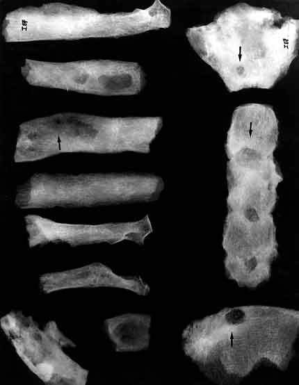 Nesta foto vê-se uma radiografia de porções de ossos humanos.