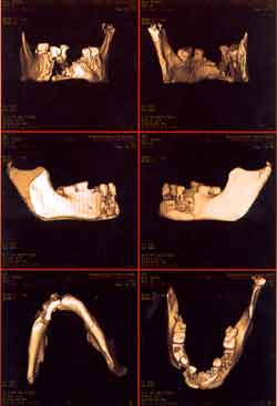 Observa-se imagem de tomografia computadorizada de mandíbula humana, em seis ângulos.