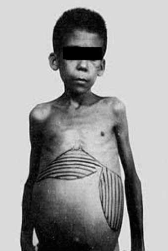 Foto em preto e branco de um menino com esquistossomose. Ele está de frente para a câmera, com uma feição séria. Percebe-se, pelos ombros e braços, que a criança está magra, no entanto, a barriga está muito inchada, atingindo a desproporcionalidade em relação ao corpo. 